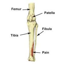 That Nagging Shin Pain…The Good, The Bad and The Ugly | Orthopedic One